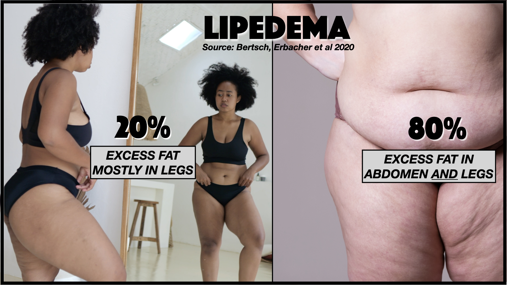 Lipedema: how often is excess fat only below the waist?